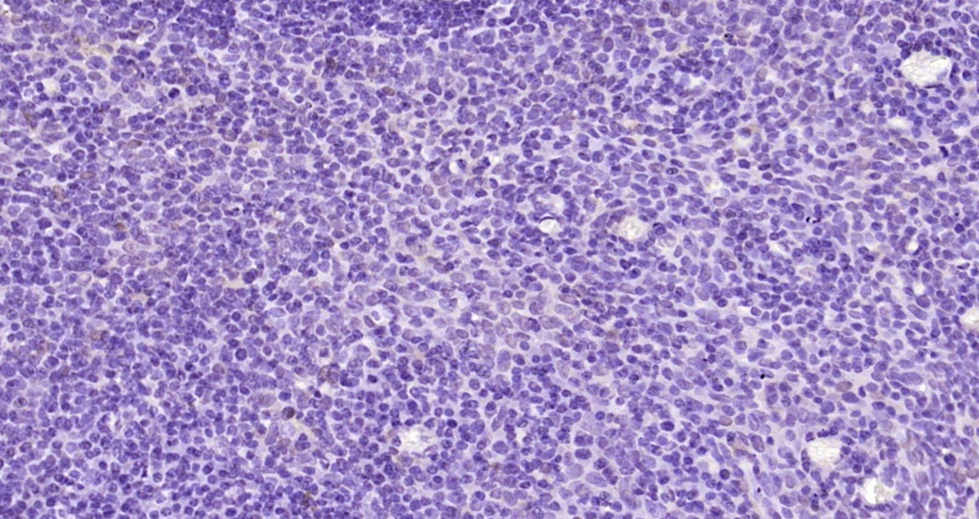 Paraformaldehyde-fixed, paraffin embedded Human tonsil; Antigen retrieval by boiling in sodium citrate buffer (pH6.0) for 15min; Block endogenous peroxidase by 3% hydrogen peroxide for 20 minutes; Blocking buffer (normal goat serum) at 37°C for 30min; Antibody incubation with _x000D_ Bcl2 Monoclonal Antibody, Unconjugated (bsm-33047M) at 1:200 overnight at 4°C, DAB staining.