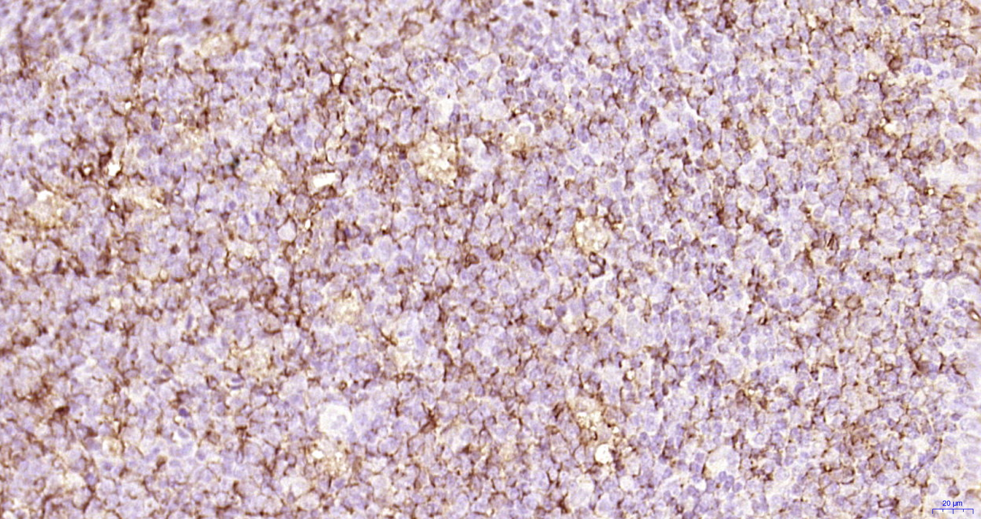 Paraformaldehyde-fixed, paraffin embedded Human tonsil; Antigen retrieval by boiling in sodium citrate buffer (pH6.0) for 15min; Block endogenous peroxidase by 3% hydrogen peroxide for 20 minutes; Blocking buffer (normal goat serum) at 37°C for 30min; Antibody incubation with CD45 Monoclonal Antibody, Unconjugated (bsm-33052M) at 1:200 overnight at 4°C, DAB staining.