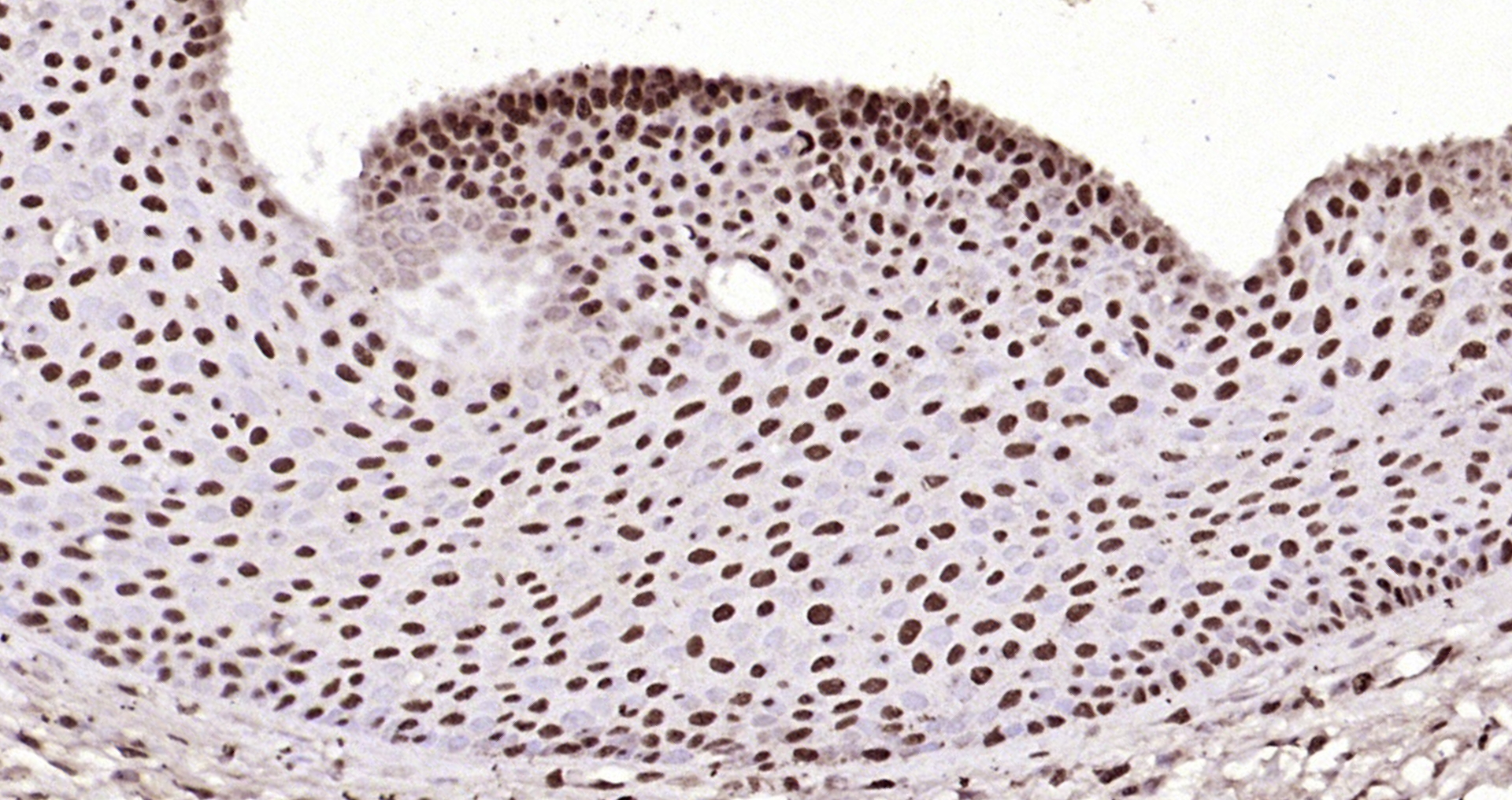 Paraformaldehyde-fixed, paraffin embedded Human laryngeal cancer; Antigen retrieval by boiling in sodium citrate buffer (pH6.0) for 15min; Block endogenous peroxidase by 3% hydrogen peroxide for 20 minutes; Blocking buffer (normal goat serum) at 37°C for 30min; Antibody incubation with Histone H3 Polyclonal Antibody, Unconjugated (bs-0349R) at 1:200 overnight at 4°C, DAB staining.