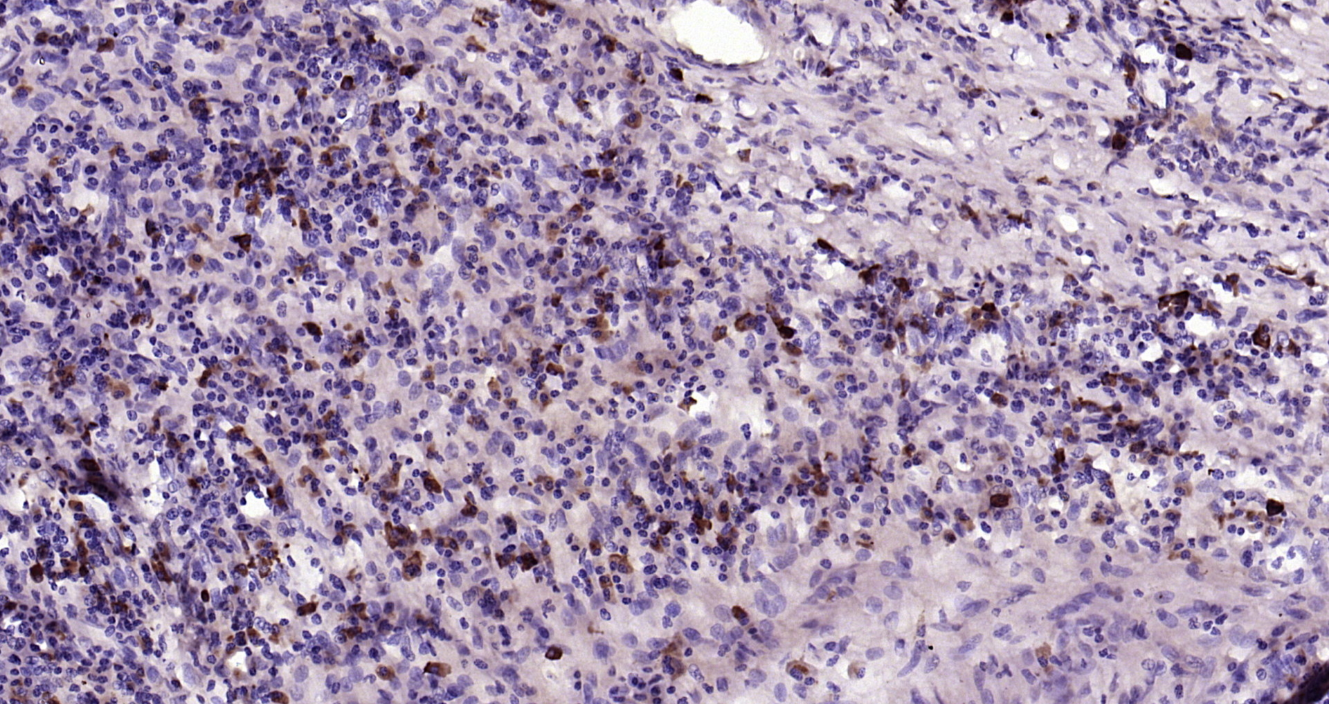 Paraformaldehyde-fixed, paraffin embedded Human colon cancer; Antigen retrieval by boiling in sodium citrate buffer (pH6.0) for 15min; Block endogenous peroxidase by 3% hydrogen peroxide for 20 minutes; Blocking buffer (normal goat serum) at 37°C for 30min; Antibody incubation with _x000D_ IL-2 Polyclonal Antibody, Unconjugated (bs-10274R) at 1:200 overnight at 4°C, DAB staining.