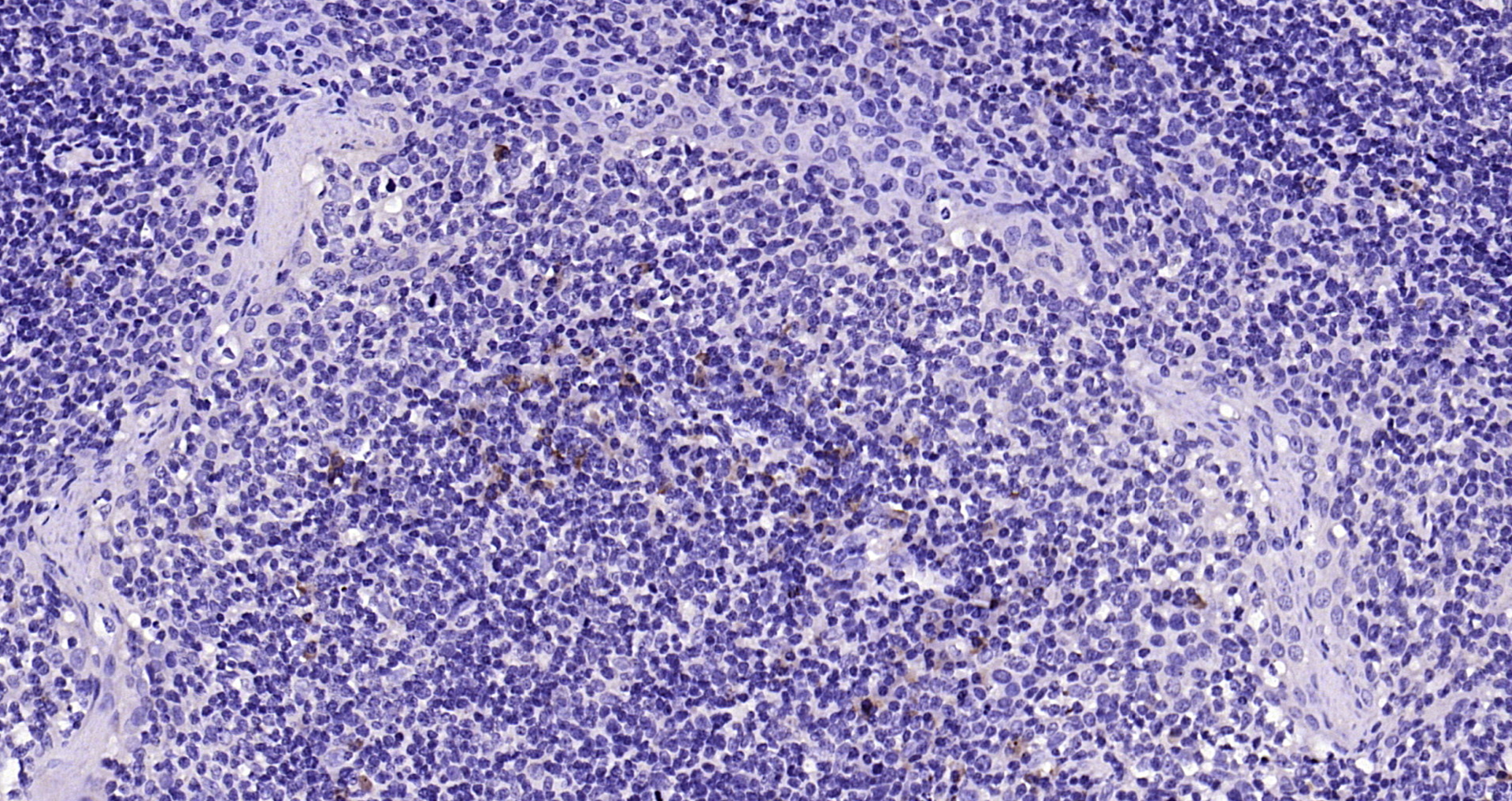 Paraformaldehyde-fixed, paraffin embedded Human tonsil; Antigen retrieval by boiling in sodium citrate buffer (pH6.0) for 15min; Block endogenous peroxidase by 3% hydrogen peroxide for 20 minutes; Blocking buffer (normal goat serum) at 37°C for 30min; Antibody incubation with IL-2 Polyclonal Antibody, Unconjugated (bs-10274R) at 1:200 overnight at 4°C, DAB staining.