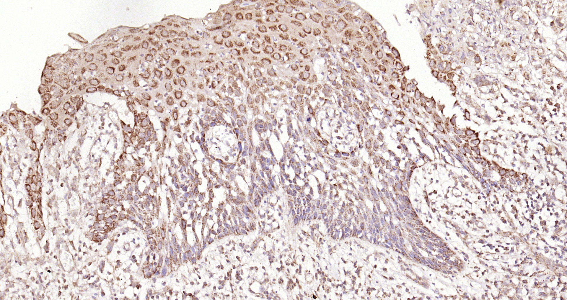 Paraformaldehyde-fixed, paraffin embedded Human laryngeal cancer; Antigen retrieval by boiling in sodium citrate buffer (pH6.0) for 15min; Block endogenous peroxidase by 3% hydrogen peroxide for 20 minutes; Blocking buffer (normal goat serum) at 37°C for 30min; Antibody incubation with Galectin 3 Polyclonal Antibody, Unconjugated (bs-0721R) at 1:200 overnight at 4°C, DAB staining.