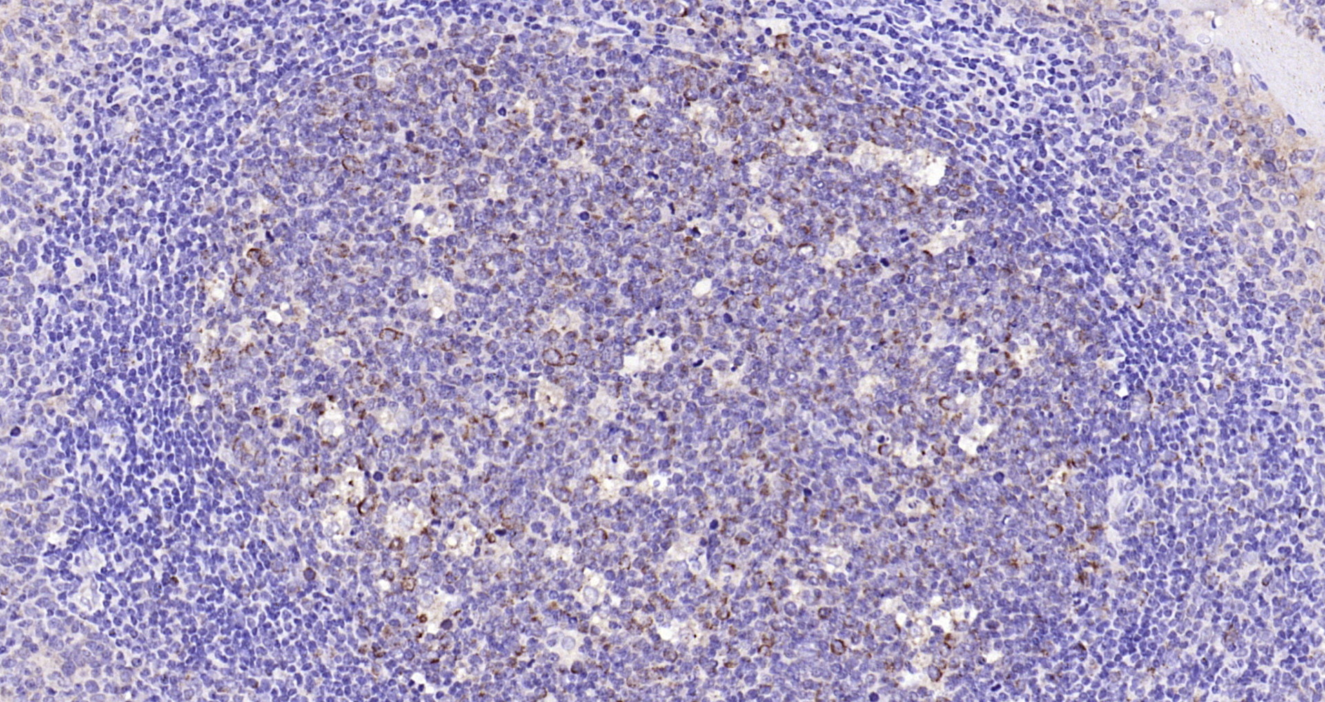 Paraformaldehyde-fixed, paraffin embedded Human tonsil; Antigen retrieval by boiling in sodium citrate buffer (pH6.0) for 15min; Block endogenous peroxidase by 3% hydrogen peroxide for 20 minutes; Blocking buffer (normal goat serum) at 37°C for 30min; Antibody incubation with Galectin 3 Polyclonal Antibody, Unconjugated (bs-0721R) at 1:200 overnight at 4°C, DAB staining.
