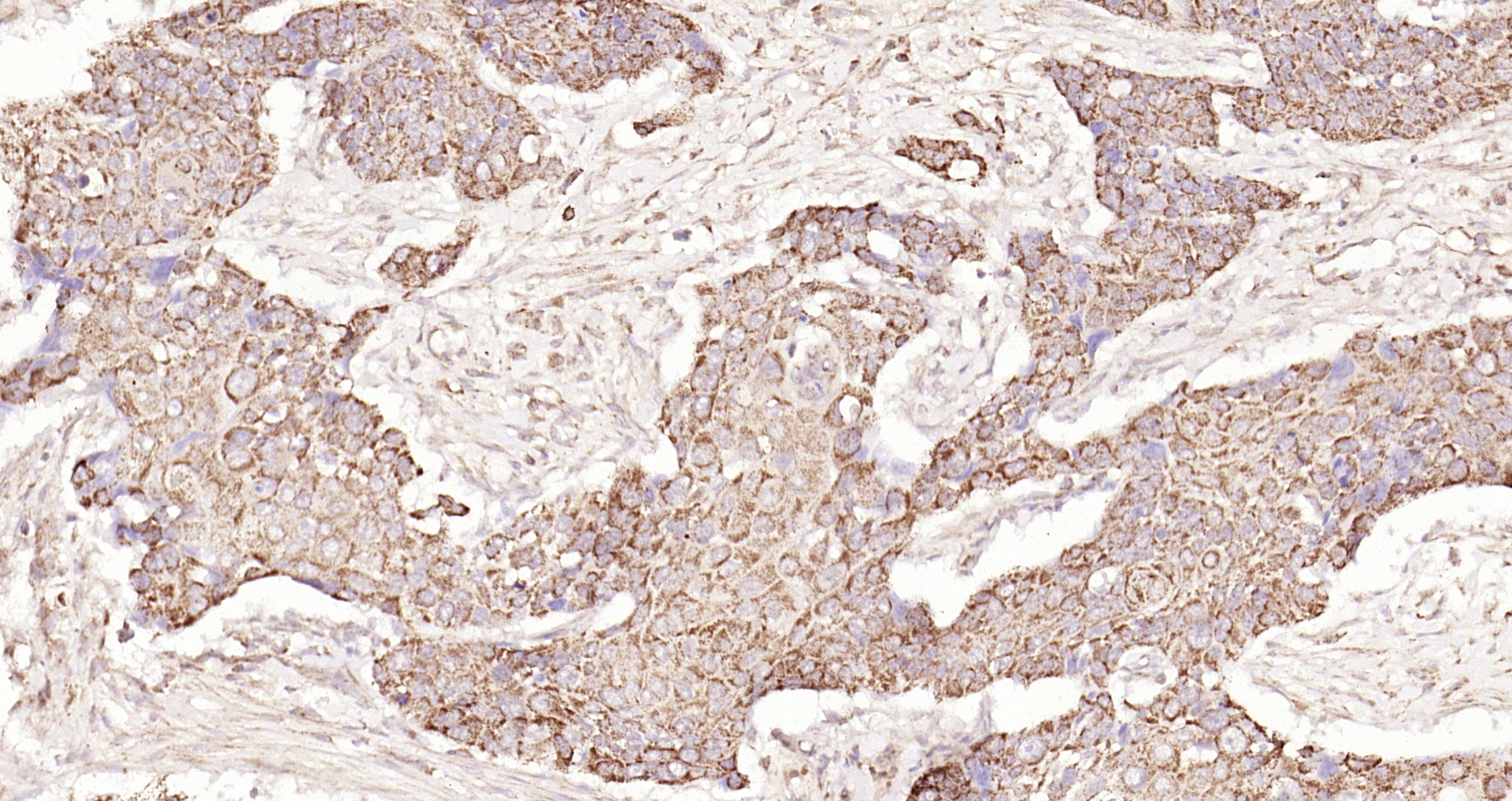 Paraformaldehyde-fixed, paraffin embedded Human esophageal carcinoma; Antigen retrieval by boiling in sodium citrate buffer (pH6.0) for 15min; Block endogenous peroxidase by 3% hydrogen peroxide for 20 minutes; Blocking buffer (normal goat serum) at 37°C for 30min; Antibody incubation with Galectin 3 Polyclonal Antibody, Unconjugated (bs-0721R) at 1:200 overnight at 4°C, DAB staining.