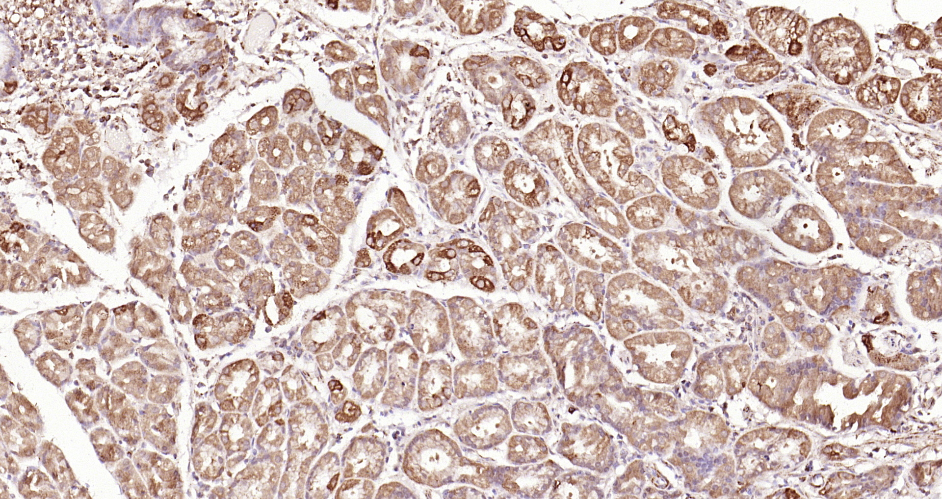 Paraformaldehyde-fixed, paraffin embedded Human gastric carcinoma; Antigen retrieval by boiling in sodium citrate buffer (pH6.0) for 15min; Block endogenous peroxidase by 3% hydrogen peroxide for 20 minutes; Blocking buffer (normal goat serum) at 37°C for 30min; Antibody incubation with Galectin 3 Polyclonal Antibody, Unconjugated (bs-0721R) at 1:200 overnight at 4°C, DAB staining.