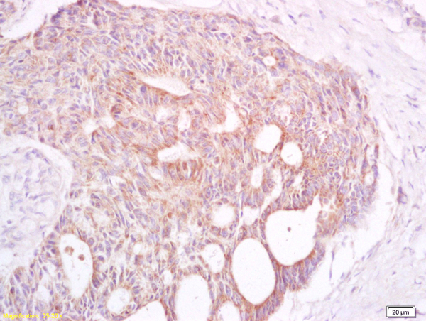 Formalin-fixed and paraffin embedded human rectal carcinoma labeled with Anti TAAL6/Transmembrane 4 L6 family member 1 Polyclonal Antibody, Unconjugated (bs-6242R) at 1:200 followed by conjugation to the secondary antibody and DAB staining Formalin-fixed and paraffin embedded human rectal carcinoma labeled with Anti TAAL6/Transmembrane 4 L6 family member 1 Polyclonal Antibody, Unconjugated (bs-6242R) at 1:200 followed by conjugation to the secondary antibody and DAB staining