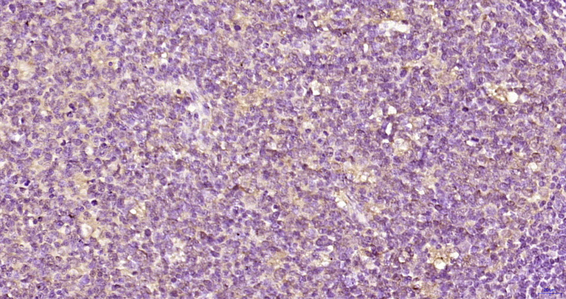 Paraformaldehyde-fixed, paraffin embedded Human tonsil; Antigen retrieval by boiling in sodium citrate buffer (pH6.0) for 15min; Block endogenous peroxidase by 3% hydrogen peroxide for 20 minutes; Blocking buffer (normal goat serum) at 37°C for 30min; Antibody incubation with EDC4 Polyclonal Antibody, Unconjugated (bs-10953R) at 1:200 overnight at 4°C, DAB staining.