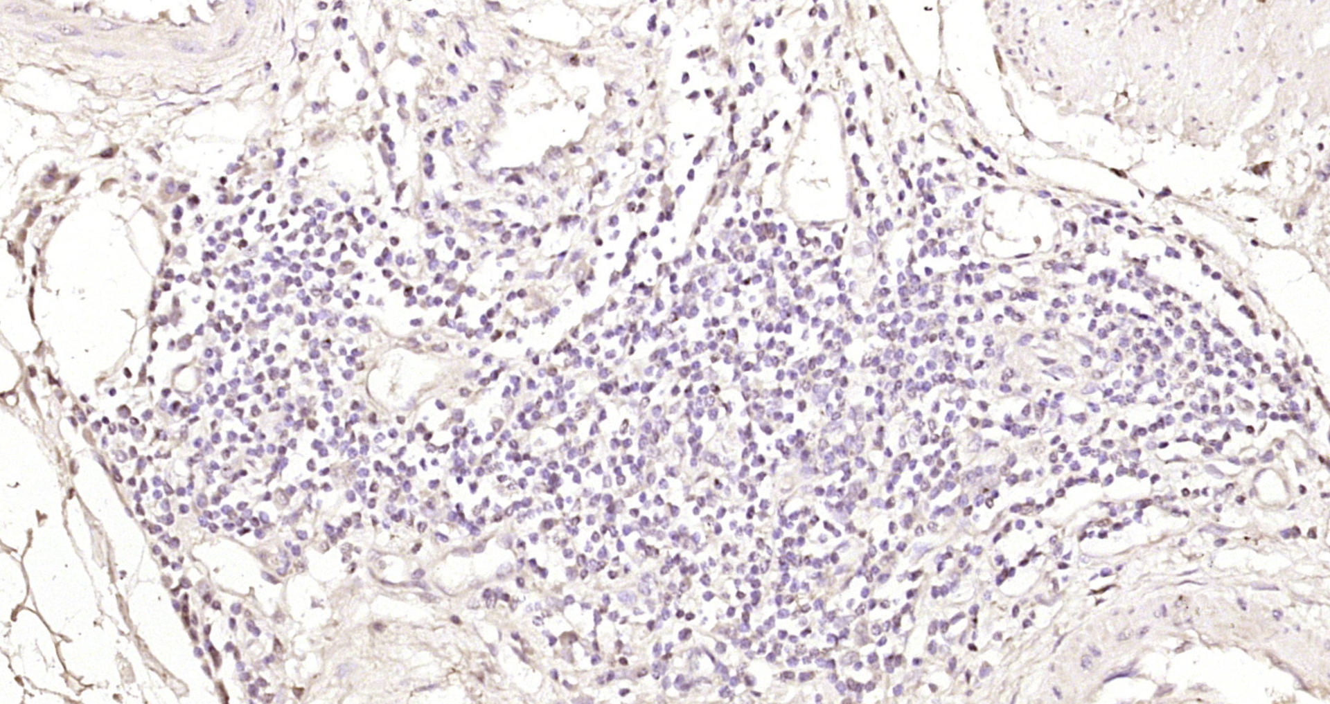 Paraformaldehyde-fixed, paraffin embedded Human cervical cancer; Antigen retrieval by boiling in sodium citrate buffer (pH6.0) for 15min; Block endogenous peroxidase by 3% hydrogen peroxide for 20 minutes; Blocking buffer (normal goat serum) at 37°C for 30min; Antibody incubation with Exportin T Polyclonal Antibody, Unconjugated (bs-14673R) at 1:200 overnight at 4°C, DAB staining.