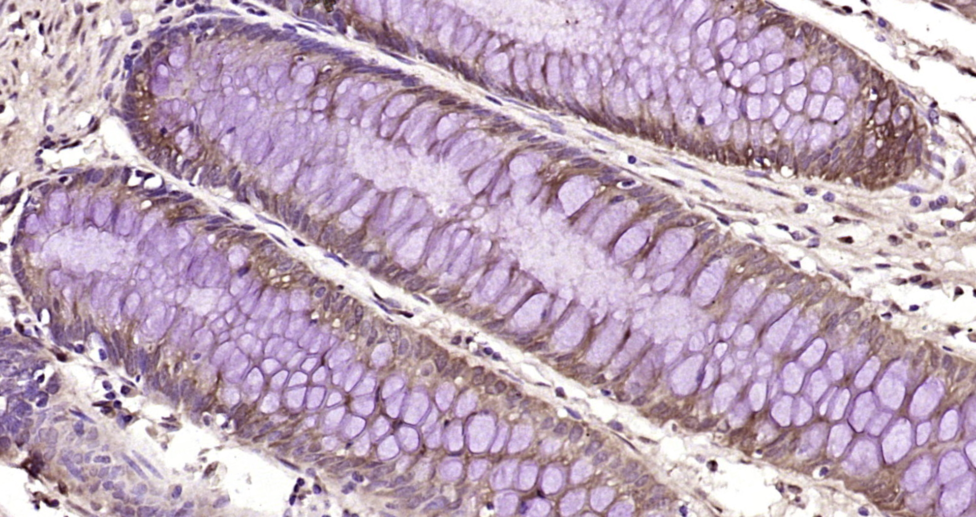 Paraformaldehyde-fixed, paraffin embedded Human colon cancer; Antigen retrieval by boiling in sodium citrate buffer (pH6.0) for 15min; Block endogenous peroxidase by 3% hydrogen peroxide for 20 minutes; Blocking buffer (normal goat serum) at 37°C for 30min; Antibody incubation with PLK4/STK18 Polyclonal Antibody, Unconjugated (bs-22111R) at 1:200 overnight at 4°C, DAB staining.