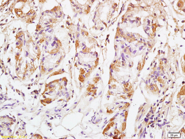 Formalin-fixed and paraffin embedded human colon carcinoma labeled with Anti GM130 Polyclonal Antibody, Unconjugated (bs-8155R) at 1:200 followed by conjugation to the secondary antibody and DAB staining Formalin-fixed and paraffin embedded human colon carcinoma labeled with Anti GM130 Polyclonal Antibody, Unconjugated (bs-8155R) at 1:200 followed by conjugation to the secondary antibody and DAB staining