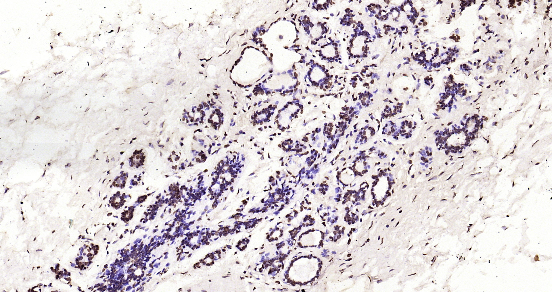 Paraformaldehyde-fixed, paraffin embedded Human breast; Antigen retrieval by boiling in sodium citrate buffer (pH6.0) for 15min; Block endogenous peroxidase by 3% hydrogen peroxide for 20 minutes; Blocking buffer (normal goat serum) at 37°C for 30min; Antibody incubation with Histone H3(di methyl K27) Monoclonal Antibody, Unconjugated (bsm-33107M) at 1:200 overnight at 4°C, DAB staining.