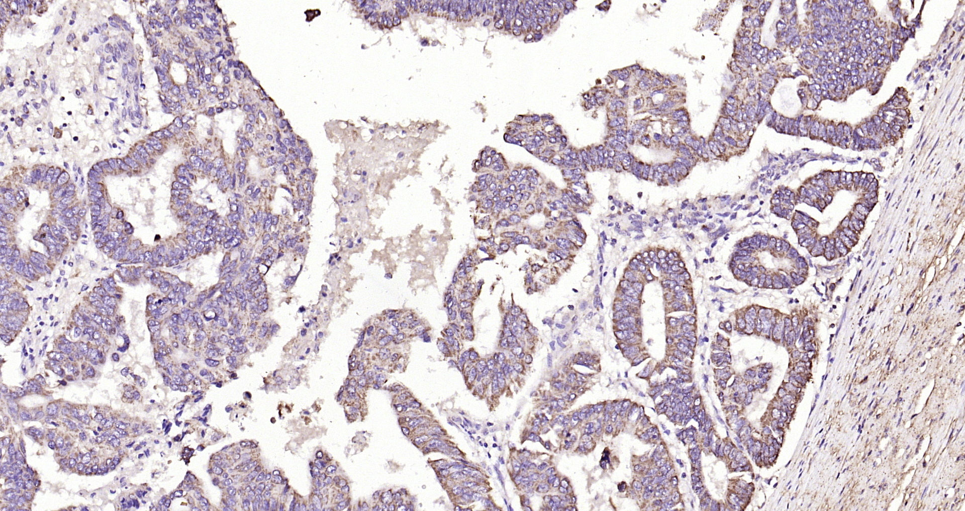 Paraformaldehyde-fixed, paraffin embedded Human colon cancer; Antigen retrieval by boiling in sodium citrate buffer (pH6.0) for 15min; Block endogenous peroxidase by 3% hydrogen peroxide for 20 minutes; Blocking buffer (normal goat serum) at 37°C for 30min; Antibody incubation with MCL1 Polyclonal Antibody, Unconjugated (bs-23315R) at 1:200 overnight at 4°C, DAB staining.