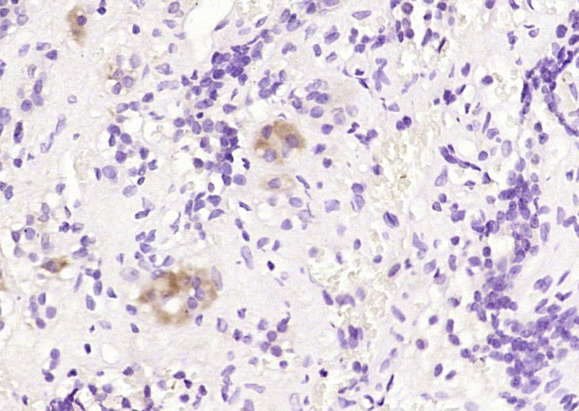 Paraformaldehyde-fixed, paraffin embedded Human pituitarytumor; Antigen retrieval by boiling in sodium citrate buffer (pH6.0) for 15min; Block endogenous peroxidase by 3% hydrogen peroxide for 20 minutes; Blocking buffer (normal goat serum) at 37°C for 30min; Antibody incubation with _x000D_ FSH/FSHB Polyclonal Antibody, Unconjugated (bs-1536R) at 1:200 overnight at 4°C, DAB staining.