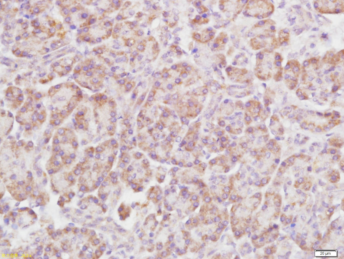 Paraformaldehyde-fixed, paraffin embedded Human pancreatic cancer; Antigen retrieval by boiling in sodium citrate buffer (pH6.0) for 15min; Block endogenous peroxidase by 3% hydrogen peroxide for 20 minutes; Blocking buffer (normal goat serum) at 37°C for 30min; Antibody incubation with Rho B Polyclonal Antibody, Unconjugated (bs-11142R) at 1:400 overnight at 4°C, DAB staining.