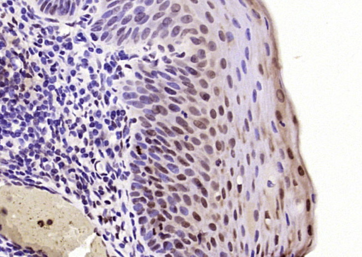 Paraformaldehyde-fixed, paraffin embedded Human tonsil; Antigen retrieval by boiling in sodium citrate buffer (pH6.0) for 15min; Block endogenous peroxidase by 3% hydrogen peroxide for 20 minutes; Blocking buffer (normal goat serum) at 37°C for 30min; Antibody incubation with SP2 transcription factor Polyclonal Antibody, Unconjugated (bs-17612R) at 1:200 overnight at 4°C, DAB staining. Paraformaldehyde-fixed, paraffin embedded Human tonsil; Antigen retrieval by boiling in sodium citrate buffer (pH6.0) for 15min; Block endogenous peroxidase by 3% hydrogen peroxide for 20 minutes; Blocking buffer (normal goat serum) at 37°C for 30min; Antibody incubation with SP2 transcription factor Polyclonal Antibody, Unconjugated (bs-17612R) at 1:200 overnight at 4°C, DAB staining.