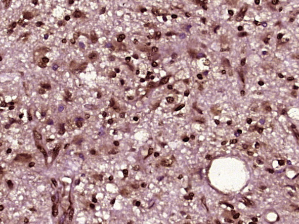 Paraformaldehyde-fixed, paraffin embedded Human brain glioma; Antigen retrieval by boiling in sodium citrate buffer (pH6.0) for 15min; Block endogenous peroxidase by 3% hydrogen peroxide for 20 minutes; Blocking buffer (normal goat serum) at 37°C for 30min; Antibody incubation with PSMC3 Polyclonal Antibody, Unconjugated (bs-19463R) at 1:400 overnight at 4°C, DAB staining.