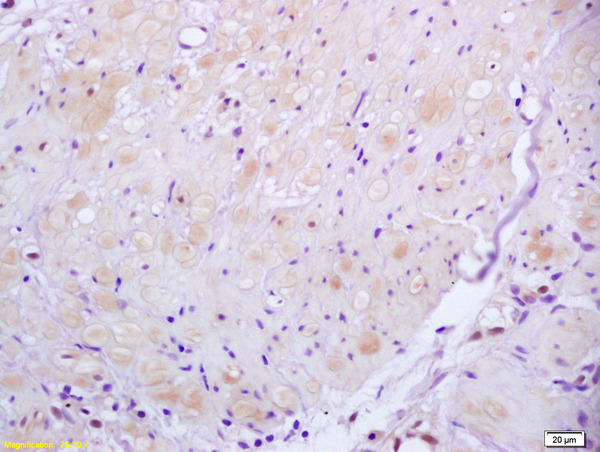 Formalin-fixed and paraffin embedded human gastric carcinoma labeled with Anti ROCK2 Polyclonal Antibody, Unconjugated (bs-1205R) at 1:200 followed by conjugation to the secondary antibody and DAB staining