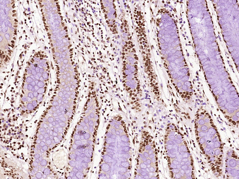 Paraformaldehyde-fixed, paraffin embedded Human colon cancer; Antigen retrieval by boiling in sodium citrate buffer (pH6.0) for 15min; Block endogenous peroxidase by 3% hydrogen peroxide for 20 minutes; Blocking buffer (normal goat serum) at 37°C for 30min; Antibody incubation with B MyB Polyclonal Antibody, Unconjugated (bs-5960R) at 1:400 overnight at 4°C, DAB staining.
