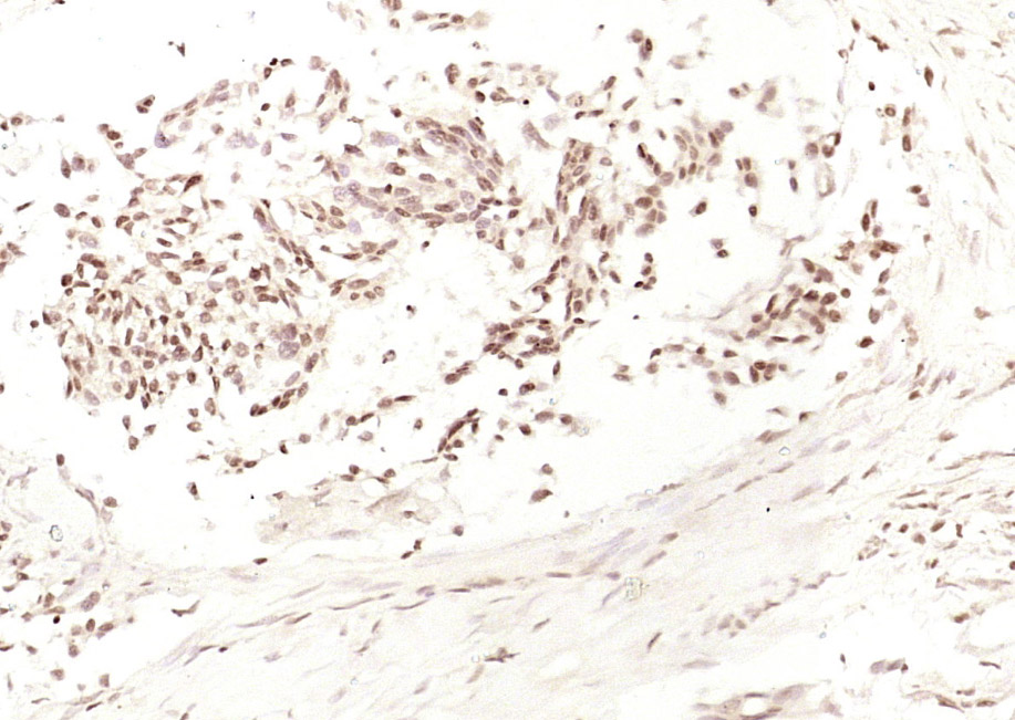 Paraformaldehyde-fixed, paraffin embedded Human gastric carcinoma; Antigen retrieval by boiling in sodium citrate buffer (pH6.0) for 15min; Block endogenous peroxidase by 3% hydrogen peroxide for 20 minutes; Blocking buffer (normal goat serum) at 37°C for 30min; Antibody incubation with HDGF Polyclonal Antibody, Unconjugated (bs-10956R) at 1:200 overnight at 4°C, DAB staining.