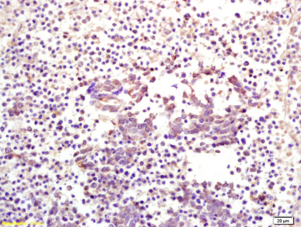 Formalin-fixed and paraffin embedded human lung carcinoma labeled with Anti CKIP-1 Polyclonal Antibody, Unconjugated (bs-1330R) at 1:200 followed by conjugation to the secondary antibody and DAB staining