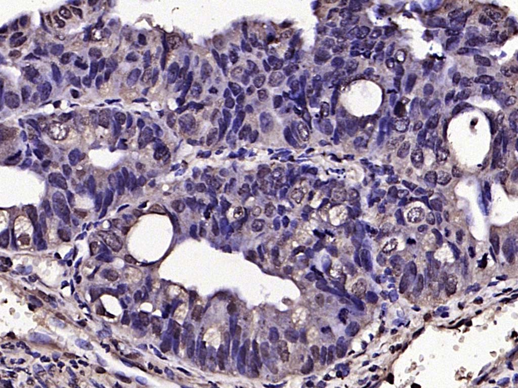 Paraformaldehyde-fixed, paraffin embedded Human colon cancer; Antigen retrieval by boiling in sodium citrate buffer (pH6.0) for 15min; Block endogenous peroxidase by 3% hydrogen peroxide for 20 minutes; Blocking buffer (normal goat serum) at 37°C for 30min; Antibody incubation with phospho-SNAIL + SLUG (Ser246) Polyclonal Antibody, Unconjugated (bs-22884R) at 1:200 overnight at 4°C, DAB staining.