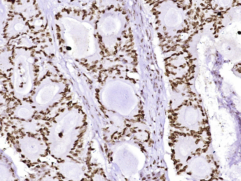 Paraformaldehyde-fixed, paraffin embedded Human colon cancer; Antigen retrieval by boiling in sodium citrate buffer (pH6.0) for 15min; Block endogenous peroxidase by 3% hydrogen peroxide for 20 minutes; Blocking buffer (normal goat serum) at 37°C for 30min; Antibody incubation with Histone H3(mono methyl K79) Monoclonal Antibody, Unconjugated (bsm-33104M) at 1:400 overnight at 4°C, DAB staining.