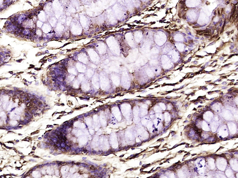 Paraformaldehyde-fixed, paraffin embedded Human colon; Antigen retrieval by boiling in sodium citrate buffer (pH6.0) for 15min; Block endogenous peroxidase by 3% hydrogen peroxide for 20 minutes; Blocking buffer (normal goat serum) at 37°C for 30min; Antibody incubation with RPS6KB1 Monoclonal Antibody, Unconjugated (bsm-33264M) at 1:400 overnight at 4°C, DAB staining.