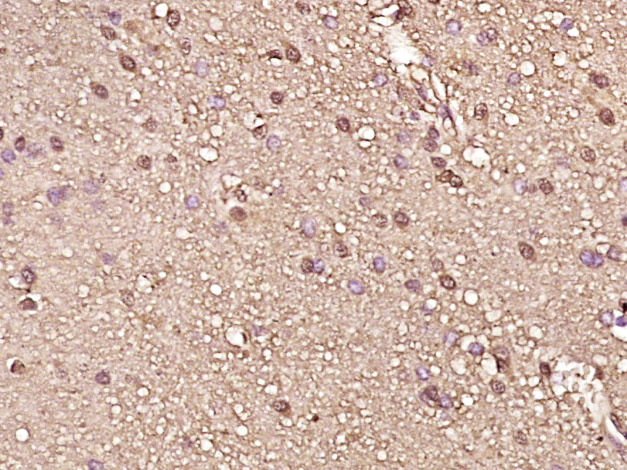 Paraformaldehyde-fixed, paraffin embedded Human brain glioma; Antigen retrieval by boiling in sodium citrate buffer (pH6.0) for 15min; Block endogenous peroxidase by 3% hydrogen peroxide for 20 minutes; Blocking buffer (normal goat serum) at 37°C for 30min; Antibody incubation with RPS6KB1 Monoclonal Antibody, Unconjugated (bsm-33264M) at 1:400 overnight at 4°C, DAB staining.