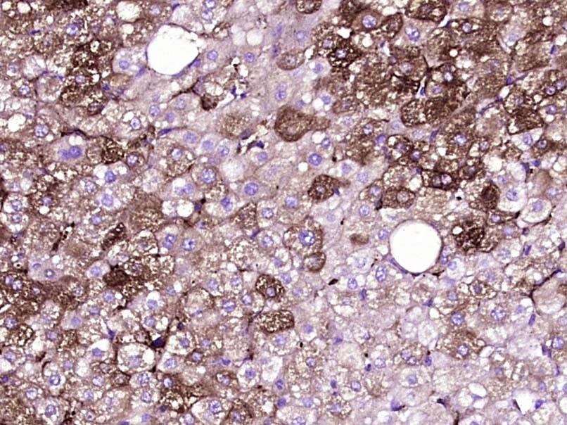 Paraformaldehyde-fixed, paraffin embedded Human liver cancer; Antigen retrieval by boiling in sodium citrate buffer (pH6.0) for 15min; Block endogenous peroxidase by 3% hydrogen peroxide for 20 minutes; Blocking buffer (normal goat serum) at 37°C for 30min; Antibody incubation with _x000D_ JAK1 Monoclonal Antibody, Unconjugated (bsm-33268M) at 1:400 overnight at 4°C, DAB staining.