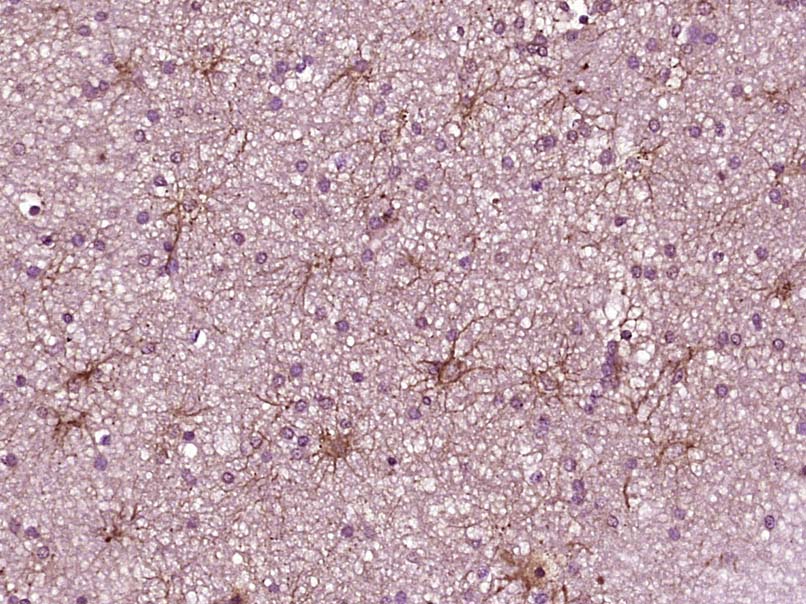Paraformaldehyde-fixed, paraffin embedded Human brain glioma; Antigen retrieval by boiling in sodium citrate buffer (pH6.0) for 15min; Block endogenous peroxidase by 3% hydrogen peroxide for 20 minutes; Blocking buffer (normal goat serum) at 37°C for 30min; Antibody incubation with _x000D_ JAK1 Monoclonal Antibody, Unconjugated (bsm-33268M) at 1:400 overnight at 4°C, DAB staining.