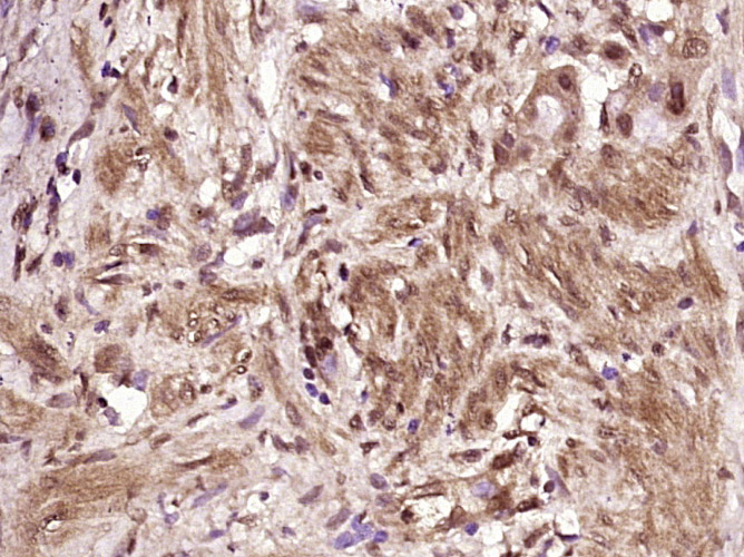 Paraformaldehyde-fixed, paraffin embedded Human gastric carcinoma; Antigen retrieval by boiling in sodium citrate buffer (pH6.0) for 15min; Block endogenous peroxidase by 3% hydrogen peroxide for 20 minutes; Blocking buffer (normal goat serum) at 37°C for 30min; Antibody incubation with Caspase-3 Monoclonal Antibody, Unconjugated (bsm-33284M) at 1:400 overnight at 4°C, DAB staining.
