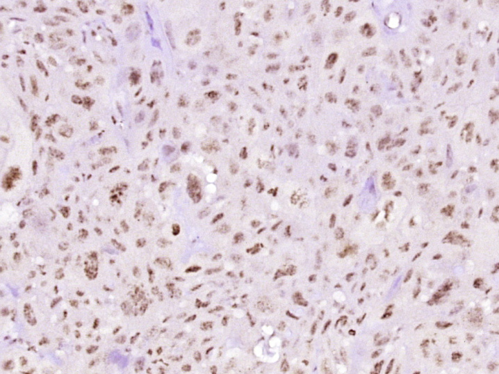 Paraformaldehyde-fixed, paraffin embedded Human laryngeal cancer; Antigen retrieval by boiling in sodium citrate buffer (pH6.0) for 15min; Block endogenous peroxidase by 3% hydrogen peroxide for 20 minutes; Blocking buffer (normal goat serum) at 37°C for 30min; Antibody incubation with STAT3 (Tyr705) Monoclonal Antibody, Unconjugated (bsm-33301M) at 1:400 overnight at 4°C, DAB staining.