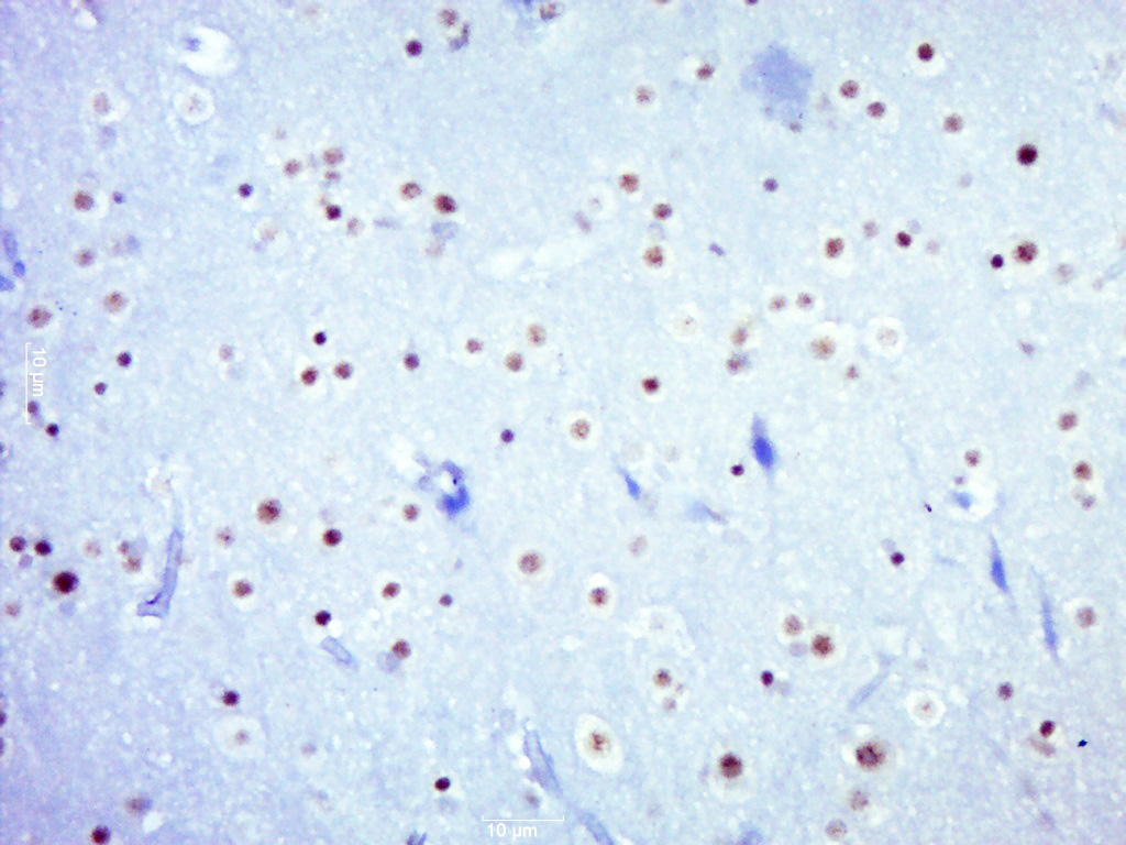 Paraformaldehyde-fixed, paraffin embedded Human brain glioma; Antigen retrieval by boiling in sodium citrate buffer (pH6.0) for 15min; Block endogenous peroxidase by 3% hydrogen peroxide for 20 minutes; Blocking buffer (normal goat serum) at 37°C for 30min; Antibody incubation with STAT3 (Tyr705) Monoclonal Antibody, Unconjugated (bsm-33301M) at 1:400 overnight at 4°C, DAB staining.