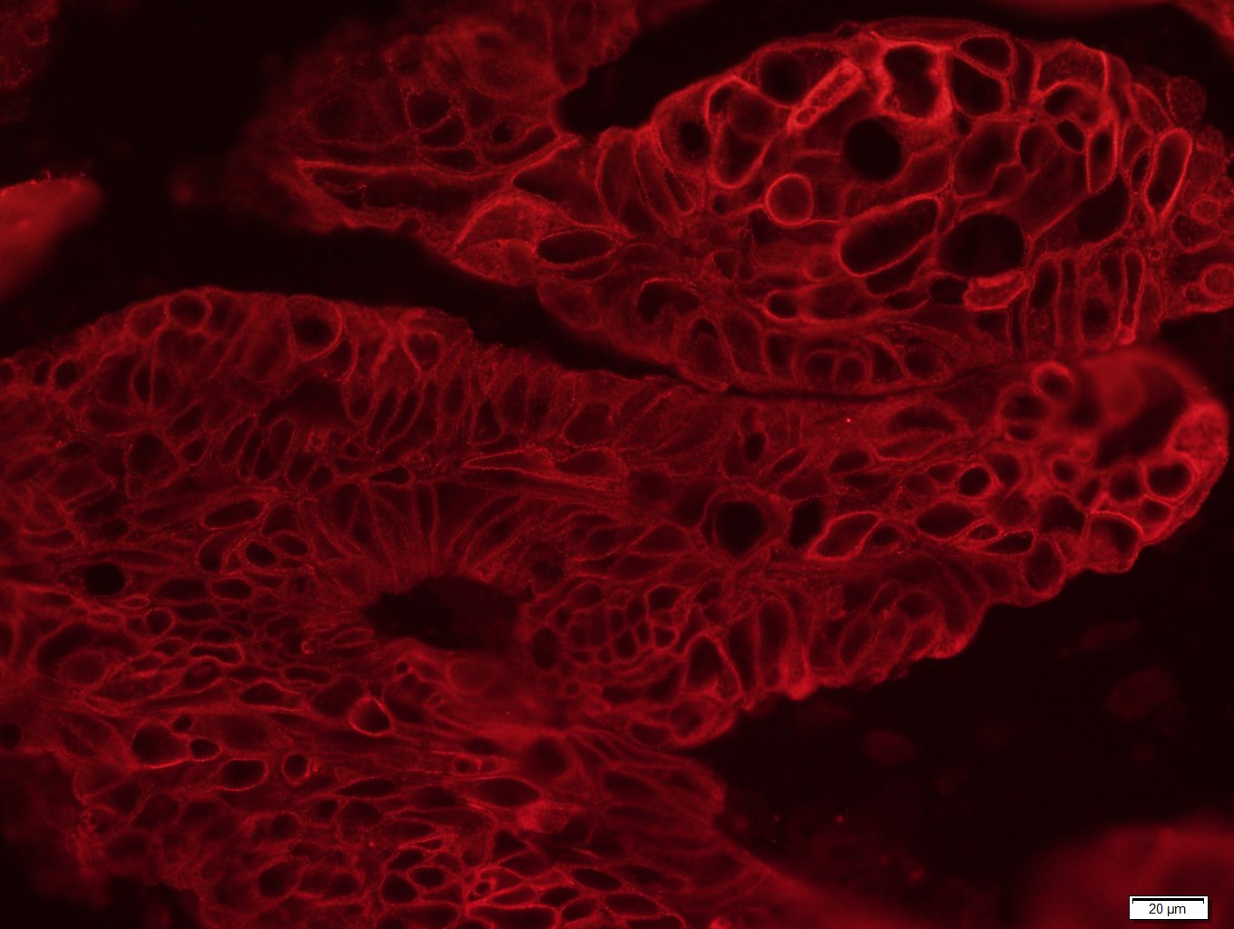 Paraformaldehyde-fixed, paraffin embedded Human cervical cancer; Antigen retrieval by boiling in sodium citrate buffer (pH6.0) for 15min; Block endogenous peroxidase by 3% hydrogen peroxide for 20 minutes; Blocking buffer (normal goat serum) at 37°C for 30min; Antibody incubation with CK16 Monoclonal Antibody, Unconjugated (bsm-33062M) at 1:400 overnight at 4°C, followed by a conjugated Goat Anti-Mouse IgG antibody (bs-0296G-cy3) for 90 minutes.