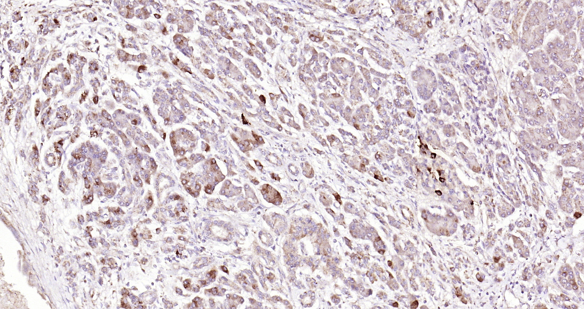 Paraformaldehyde-fixed, paraffin embedded Human pancreatic cancer; Antigen retrieval by boiling in sodium citrate buffer (pH6.0) for 15min; Block endogenous peroxidase by 3% hydrogen peroxide for 20 minutes; Blocking buffer (normal goat serum) at 37°C for 30min; Antibody incubation with GLP-1 Polyclonal Antibody, Unconjugated (bs-0038R) at 1:200 overnight at 4°C, DAB staining.