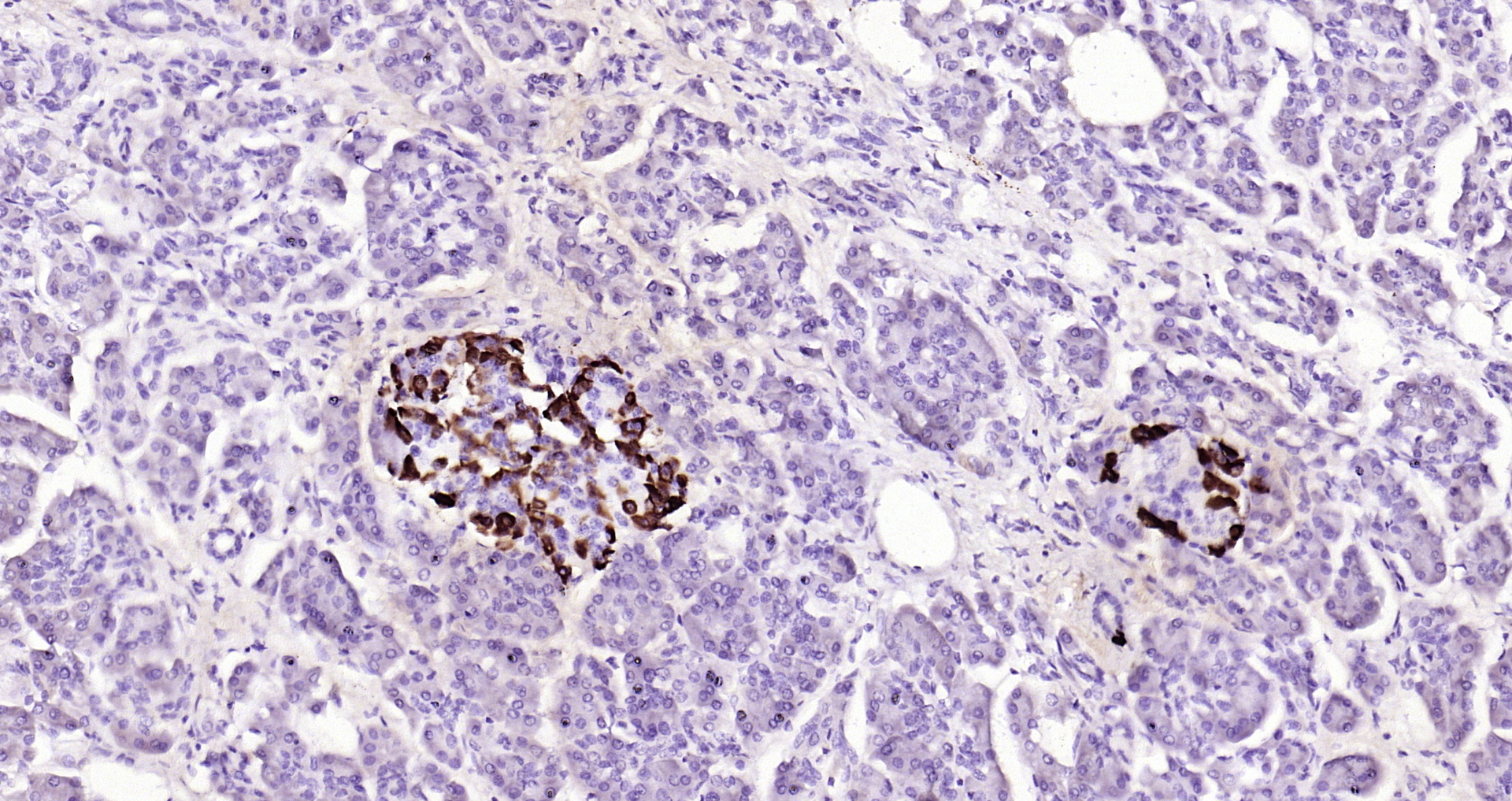 Paraformaldehyde-fixed, paraffin embedded Human pancreatic cancer; Antigen retrieval by boiling in sodium citrate buffer (pH6.0) for 15min; Block endogenous peroxidase by 3% hydrogen peroxide for 20 minutes; Blocking buffer (normal goat serum) at 37°C for 30min; Antibody incubation with GLP-1 (1G9) Monoclonal Antibody, Unconjugated (bsm-0933M) at 1:200 overnight at 4°C, DAB staining.