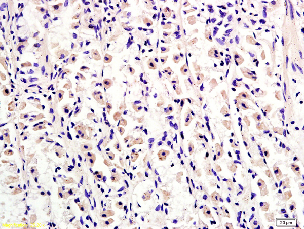 Formalin-fixed and paraffin embedded human gastric adenocarcinoma tissue labeled with Anti-Tuberin/TSC2 Polyclonal Antibody, Unconjugated(bs-3586R) at 1:300, followed by conjugation to the secondary antibody and DAB staining
