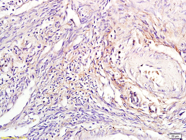Formalin-fixed and paraffin embedded human endometrial tissue labeled with Anti-Tuberin/TSC2 Polyclonal Antibody, Unconjugated(bs-3586R) at 1:300, followed by conjugation to the secondary antibody and DAB staining