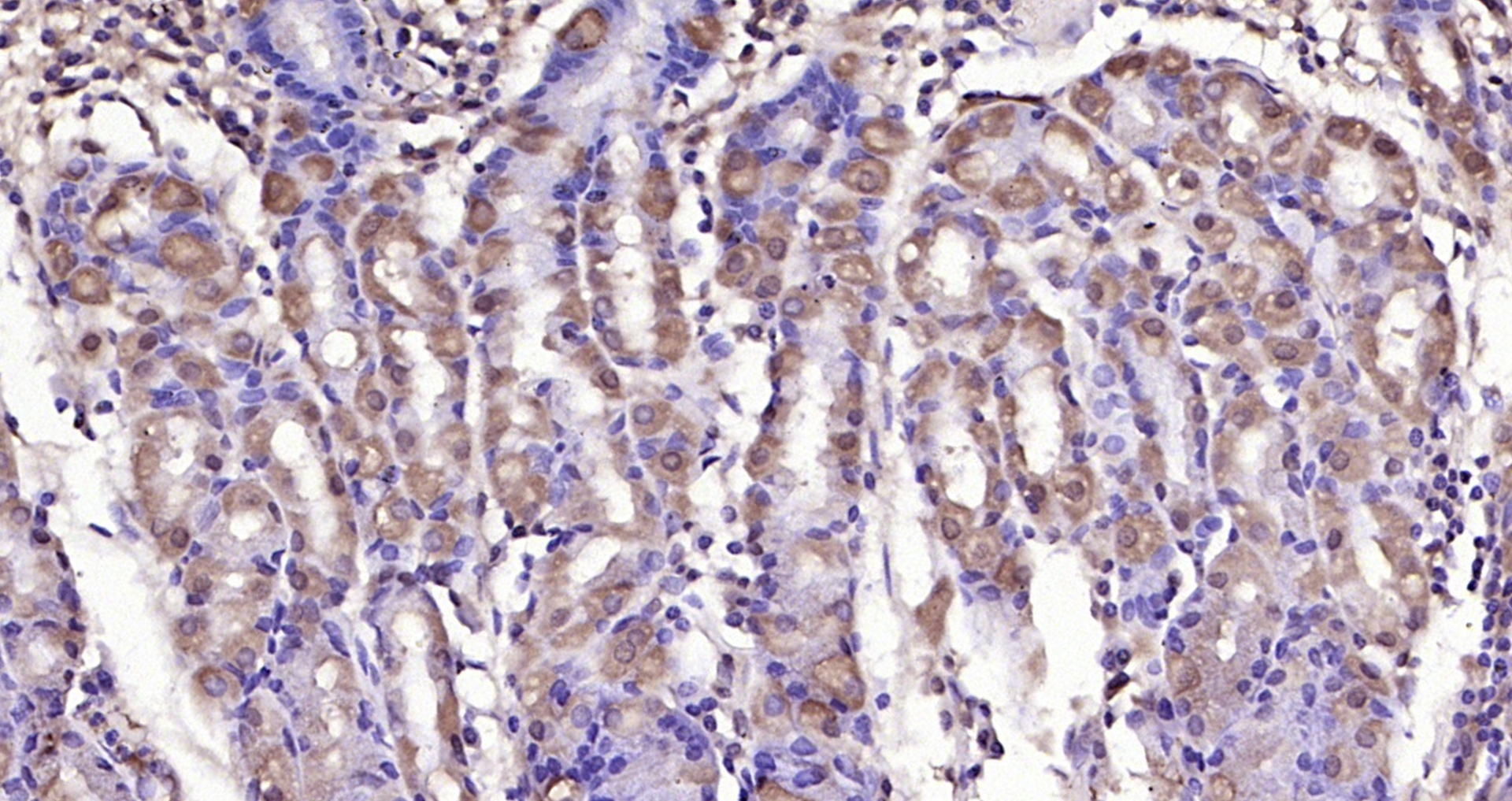 Paraformaldehyde-fixed, paraffin embedded Human gastric carcinoma; Antigen retrieval by boiling in sodium citrate buffer (pH6.0) for 15min; Block endogenous peroxidase by 3% hydrogen peroxide for 20 minutes; Blocking buffer (normal goat serum) at 37°C for 30min; Antibody incubation with GLI1 Polyclonal Antibody, Unconjugated (bs-1206R) at 1:200 overnight at 4°C, DAB staining.