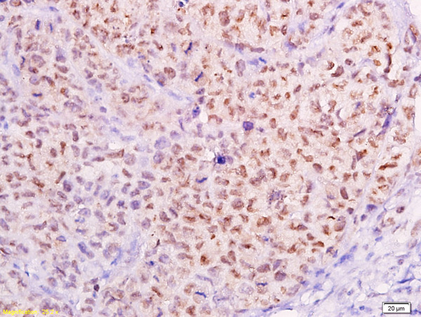 Formalin-fixed and paraffin embedded transplanted tumor of cervical carcinoma in nude mice labeled with Anti-MTA1 Polyclonal Antibody, Unconjugated(bs-1412R) at 1:300, followed by conjugation to the secondary antibody and DAB staining