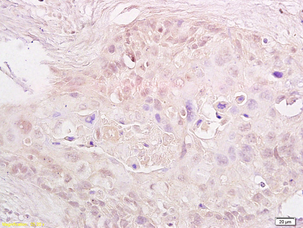 Formalin-fixed and paraffin embedded human cervical carcinoma labeled with Anti-MTA1 Polyclonal Antibody, Unconjugated(bs-1412R) at 1:600, followed by conjugation to the secondary antibody and DAB staining