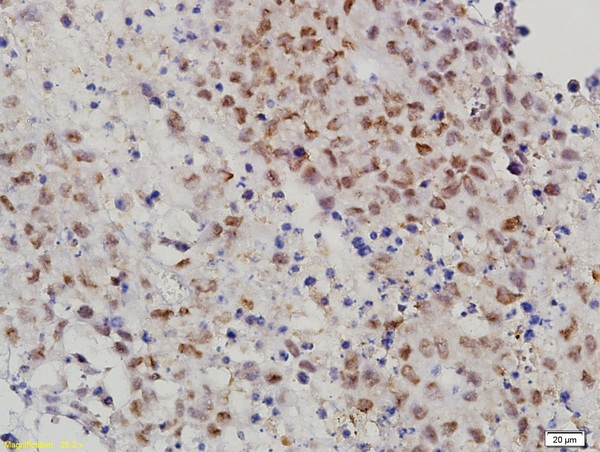 Formalin-fixed and paraffin embedded mouse cervical cancer labeled with Anti-MAT-1 Polyclonal Antibody, Unconjugated (bs-1412R) followed by conjugation to the secondary antibody and DAB staining
