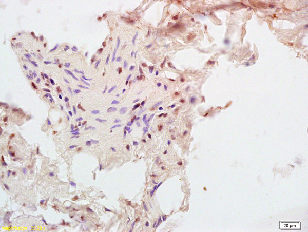 Formalin-fixed and paraffin embedded human rectal carcinoma tissue labeled with Anti-CPT1B Polyclonal Antibody, Unconjugated (bs-5045R) at 1:200, followed by conjugation to the secondary antibody and DAB staining