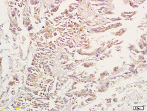 Formalin-fixed and paraffin embedded human gastric carcinoma tissue labeled with Anti-ADORA3/Adenosine A3 Receptor Polyclonal Antibody, Unconjugated(bs-1225R) at 1:200, followed by conjugation to the secondary antibody and DAB staining