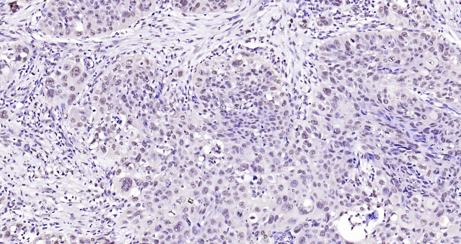 Paraformaldehyde-fixed, paraffin embedded Human laryngeal cancer; Antigen retrieval by boiling in sodium citrate buffer (pH6.0) for 15min; Block endogenous peroxidase by 3% hydrogen peroxide for 20 minutes; Blocking buffer (normal goat serum) at 37°C for 30min; Antibody incubation with SOX9 Polyclonal Antibody, Unconjugated (bs-10725R) at 1:200 overnight at 4°C, DAB staining.