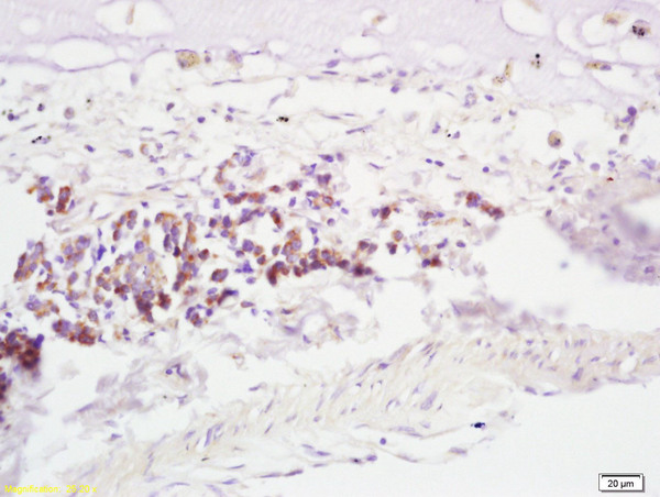 Formalin-fixed and paraffin embedded human lung carcinoma labeled with Anti-RNF43 Polyclonal Antibody, Unconjugated(bs-7007R) at 1:200, followed by conjugation to the secondary antibody and DAB staining Formalin-fixed and paraffin embedded human lung carcinoma labeled with Anti-RNF43 Polyclonal Antibody, Unconjugated(bs-7007R) at 1:200, followed by conjugation to the secondary antibody and DAB staining