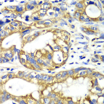 Paraformaldehyde-fixed, paraffin embedded Human gastric carcinoma; Antigen retrieval by boiling in sodium citrate buffer (pH6.0) for 15min; Block endogenous peroxidase by 3% hydrogen peroxide for 20 minutes; Blocking buffer (normal goat serum) at 37°C for 30min; Antibody incubation with AK2 Polyclonal Antibody, Unconjugated (bs-55004R) at 1:100 overnight at 4°C, DAB staining.