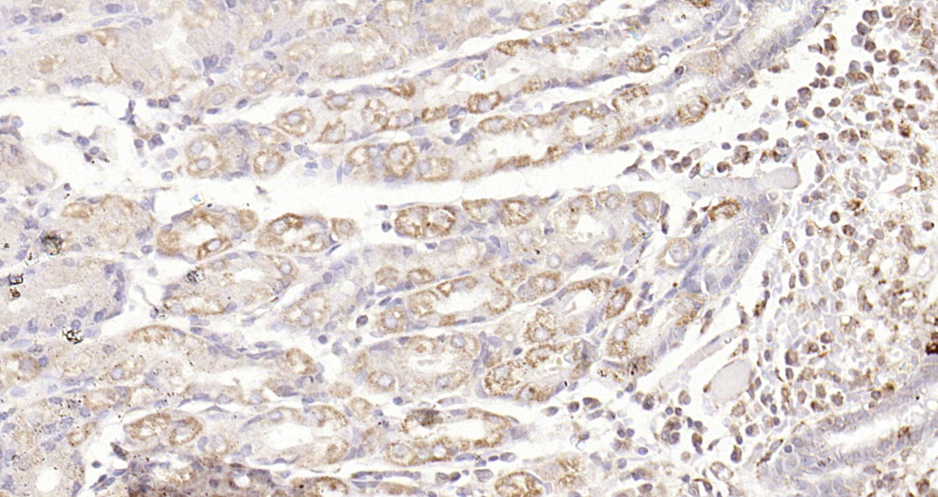 Paraformaldehyde-fixed, paraffin embedded Human gastric carcinoma; Antigen retrieval by boiling in sodium citrate buffer (pH6.0) for 15min; Block endogenous peroxidase by 3% hydrogen peroxide for 20 minutes; Blocking buffer (normal goat serum) at 37°C for 30min; Antibody incubation with TAK1(Thr187) Polyclonal Antibody, Unconjugated (bs-3438R) at 1:200 overnight at 4°C, DAB staining.