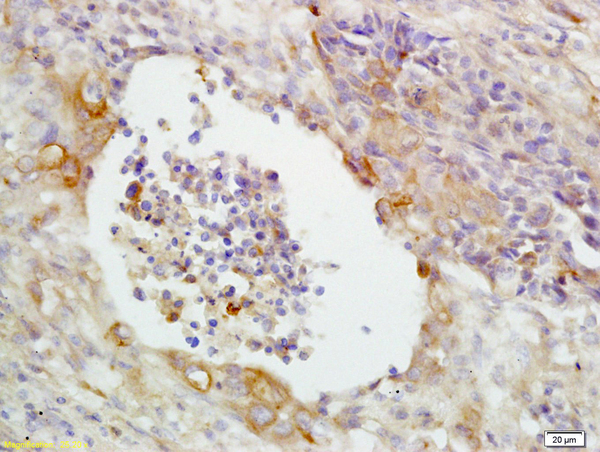 Formalin-fixed and paraffin embedded human lung carcinoma labeled with Anti-CD14 Polyclonal Antibody, Unconjugated (bs-1192R) at 1:200 followed by conjugation to the secondary antibody and DAB staining