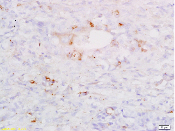 Formalin-fixed and paraffin embedded human lung carcinoma labeled with Anti-SP-D/PSPD Polyclonal Antibody, Unconjugated(bs-1538R) at 1:200, followed by conjugation to the secondary antibody and DAB staining.